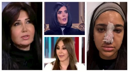 بعد أزمة كنزي مدبولي مع الفيلر.. 10 نجمات تعرضن للتشوه بسبب عمليات التجميل