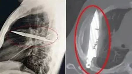 رجل يعيش 8 سنوات بشفرة سكين في صدره دون أن يدري "صور"