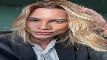 بعد وفاة مؤثر الموضة البرازيلي.. تعرف على جراحة "عيون الثعلب" ومخاطرها