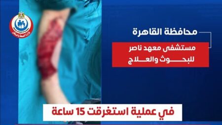 «معهد ناصر» ينقذ ساق طفل باسوس بجراحة ميكروسكوبية استمرت 15 ساعة