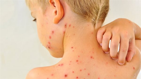 «CDC» ينشر أول بيانات لفيروس الحصبة بعد عودته للانتشار في الولايات المتحدة